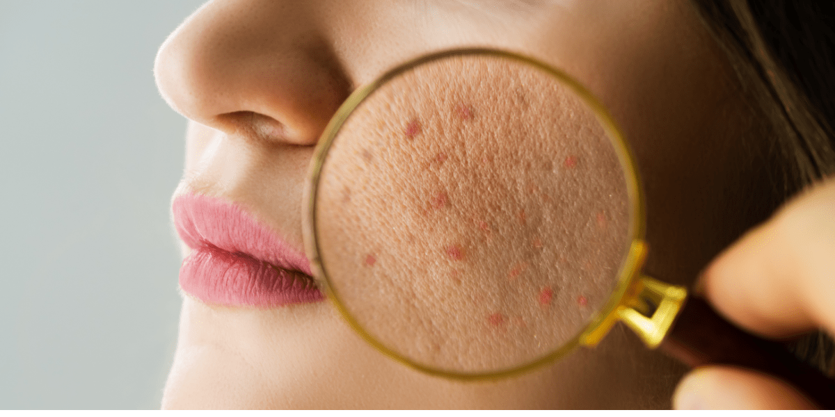 Can Chemical Peels Cause Acne?